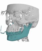 Image result for Jawbone Deterioration