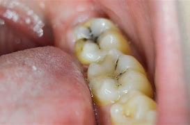 Image result for Bad Molar Teeth