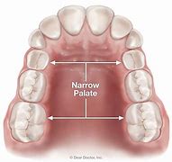 Image result for Narrow Lower Jaw