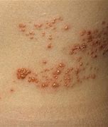 Image result for Sun Poisoning Blisters