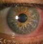 Image result for Contact Lens Acute Red Eye