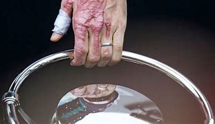 Image result for Grosjean's Burnt Hands
