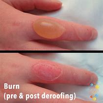 Image result for Healing Burn Blister