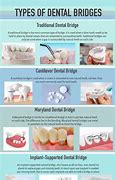 Image result for Types of Dental Bridge ES