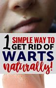 Image result for Warts On Face Removal Natural