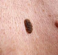Image result for Almond Oil and Seborrheic Keratosis