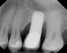 Image result for Implant Bone Loss