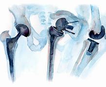 Image result for Orthopedic Clip Art