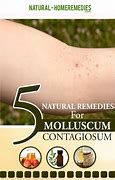 Image result for Molluscum Contagiosum Treatment Coconut Oil