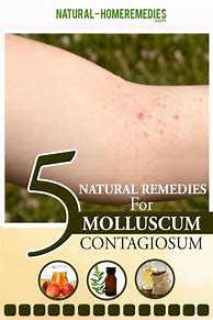 Image result for Molluscum Contagiosum Treatment Coconut Oil