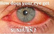 Image result for SunBurn Under Eyes