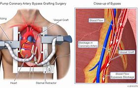 Image result for Heart and Lung Bypass