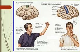 Image result for Frontal Lobe Epilepsy