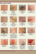 Image result for Common Skin Diseases Types