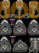 Image result for Head and Neck Irradiation