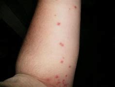 Image result for Sun Burn Rash/Bumps Pictures
