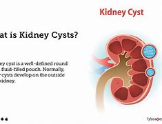 Image result for Cyst On the Kidney