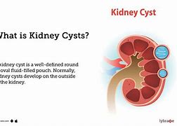Image result for Hyperdense Cyst Kidney