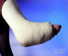 Image result for Broken Leg Plaster