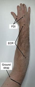 Image result for EMG Electrode Placement
