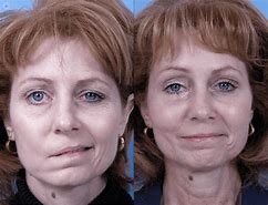 Image result for Bell's Palsy Disease