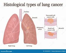 Image result for Lung Cancer Cell Diagram