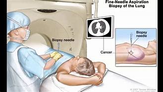 Image result for Lung Tumor Biopsy