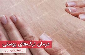 Image result for ترک بدن