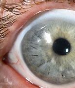 Image result for Lasik Eye Surgery Flap