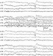Image result for Temporal Lobe Epilepsy EEG