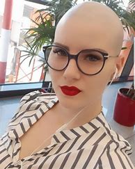 Image result for Female Face Bald
