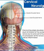 Image result for Cervical Neuralgia