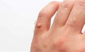 Image result for Scars From Wart Removal