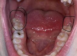 Image result for Unusual Wisdom Teeth