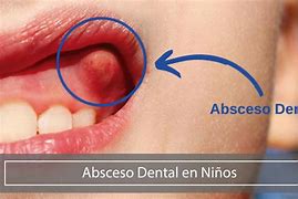 Image result for absceso