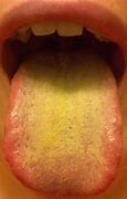 Image result for Filiform Wart Mouth