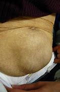 Image result for Lump in Belly Button
