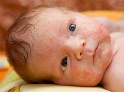 Image result for Baby Eczema Rash On Face