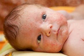 Image result for Eczema in Babies