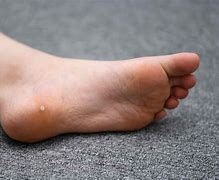 Image result for Wart On Heel of Foot