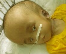 Image result for Hydrocephalus Signs and Symptoms Baby