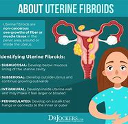 Image result for Uterus Fibrosis