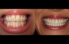 Image result for Invisalign Time-Lapse