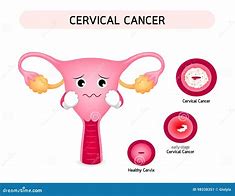 Image result for Cervical Cancer Illustration