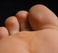 Image result for Plantar Wart On Heel of Foot