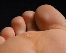 Image result for Verrucas On Feet