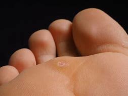 Image result for Wart Between Toes