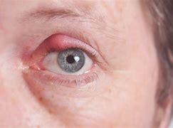 Image result for Red Swollen Itchy Eyes