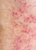 Image result for Allergy Rash Legs