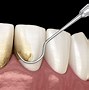 Image result for Loose Teeth Bone Loss